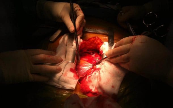 Pierwszy w Polsce zabieg wszczepienia najmniejszego stymulatora serca
